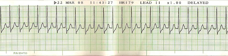 Lmh Ed Technician Cardiac Rhythm Quiz